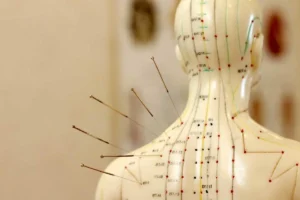 Qu'est-ce que l'acupuncture ?