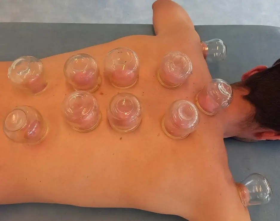 Les ventouse, un outils avec l'acupuncture, David Plourde Médecine Traitionnelle Chinoise à Brocéliande et Poitiers